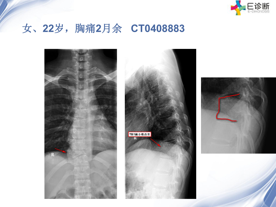 医学影像-脊柱原发性恶性淋巴瘤的影像诊断课件.ppt_第1页