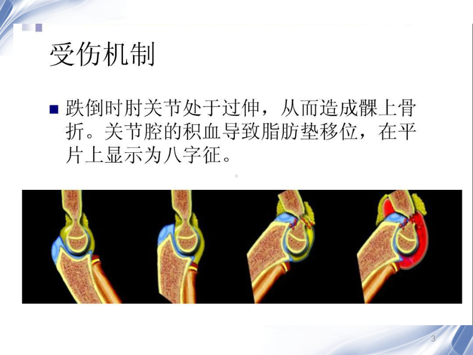 医学影像-儿童肘关节骨折X线诊断课件.ppt_第3页