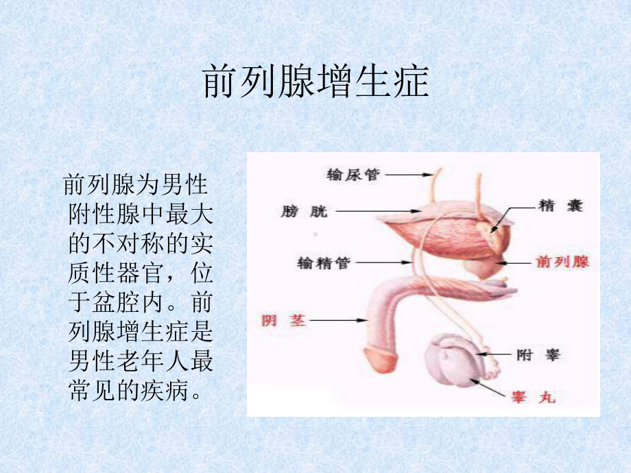 前列腺增生症课件-2.ppt_第2页