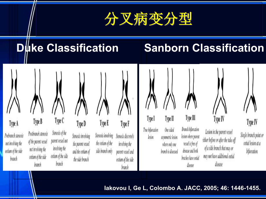 冠脉分叉病变不同介入治疗策略评价课件.ppt_第3页