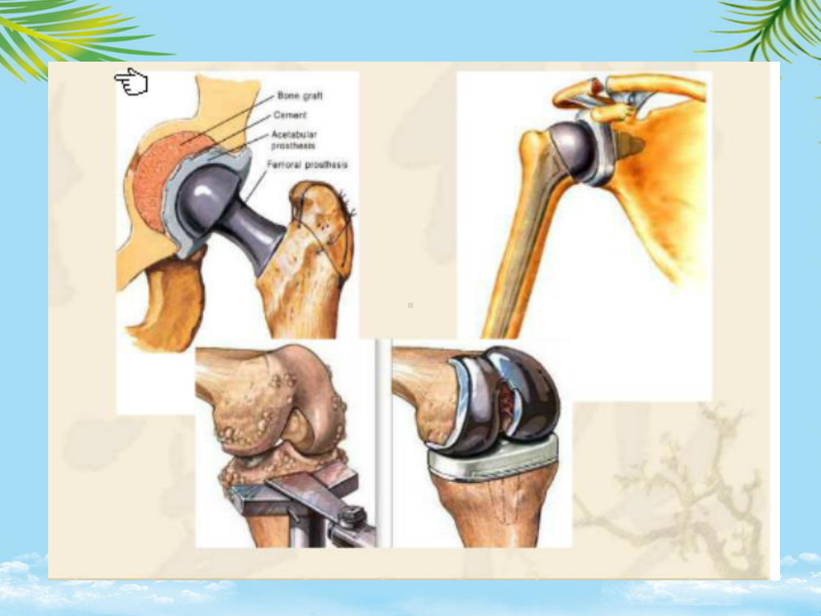 课件-关节置换术后的康复.ppt_第3页