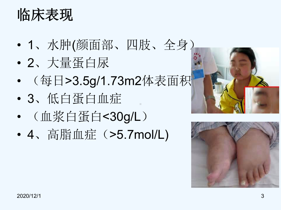 肾病综合征的护理课件-2.ppt_第3页