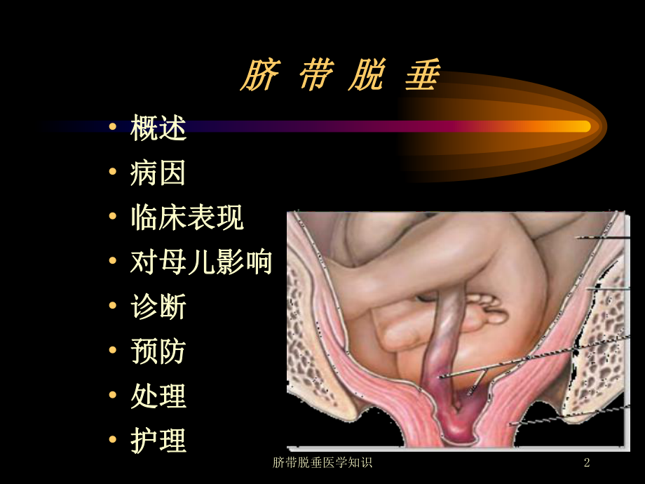 脐带脱垂医学知识培训课件.ppt_第2页