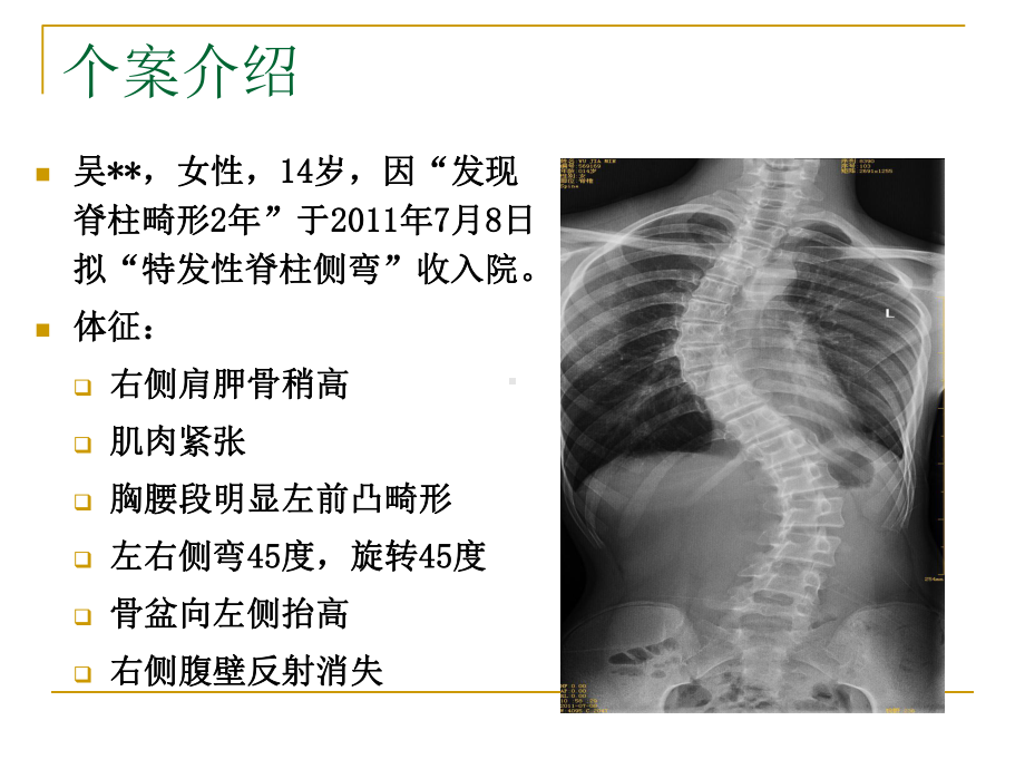 脊柱侧弯的个案护理课件.pptx_第3页