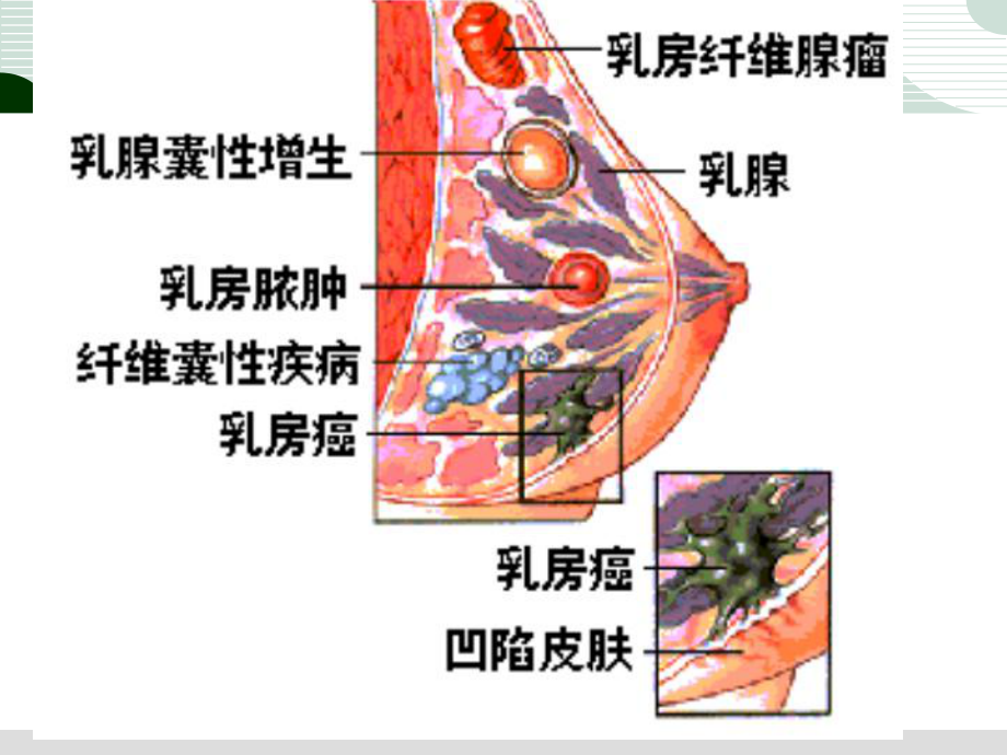 乳腺癌病人的护理(-42张)课件.ppt_第3页