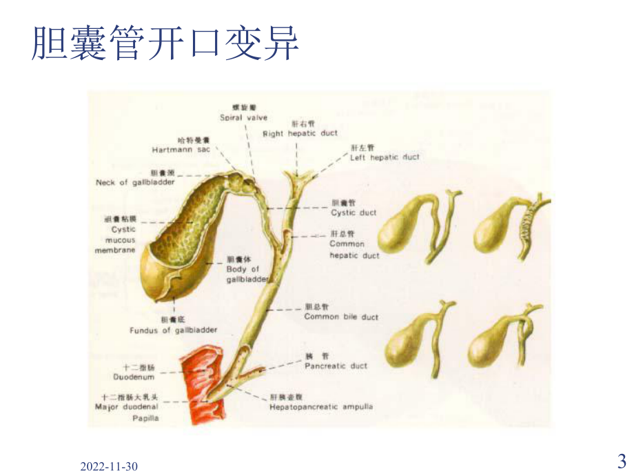 胆囊结石及其防治教材课件.ppt_第3页