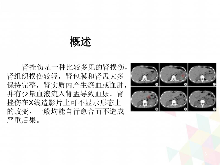 肾挫伤疑难病例讨论学习课件.ppt_第3页