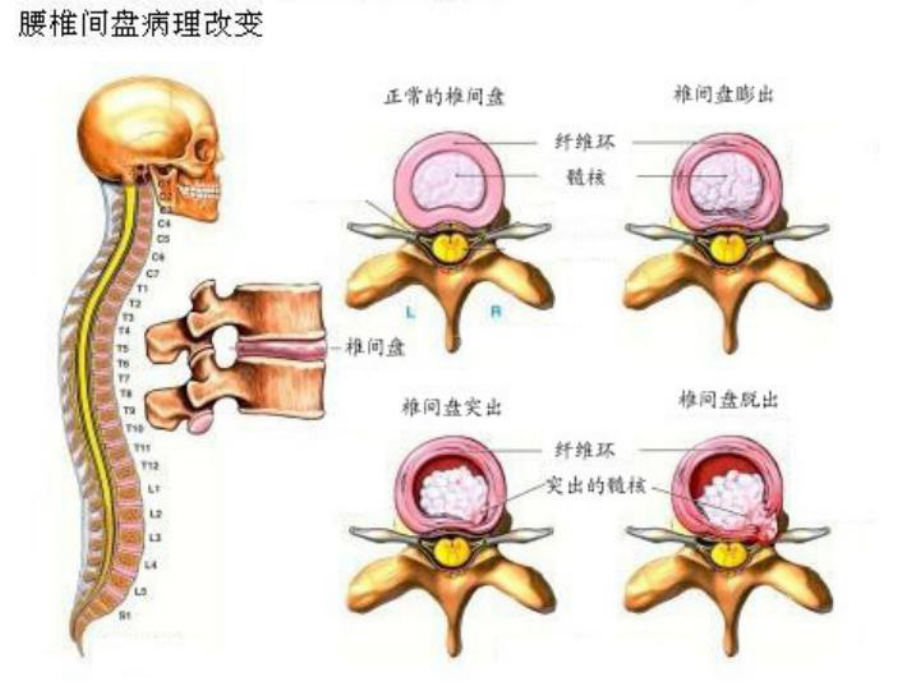 腰椎间盘突出症的预防课件.ppt_第3页