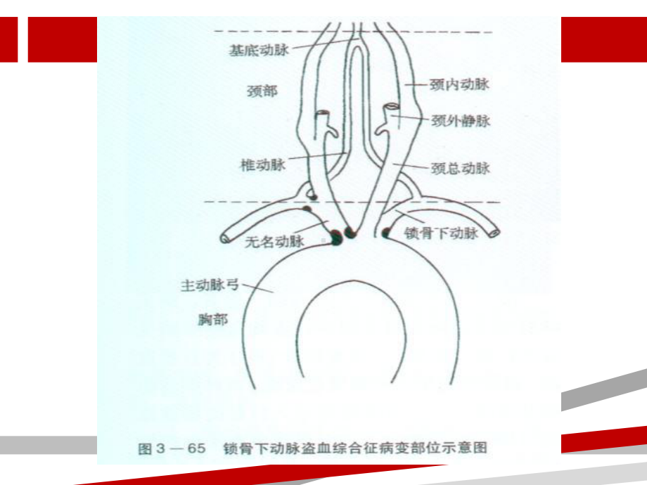 锁骨下动脉盗血综合征课件-2.ppt_第3页