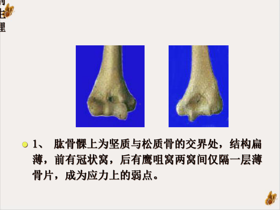 认识肱骨髁上骨折课件-2.ppt_第3页