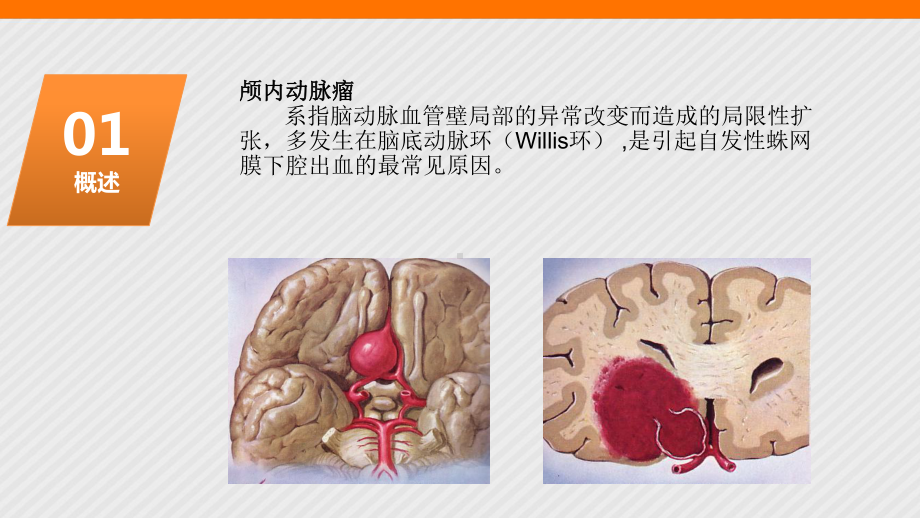 颅内动脉瘤的护理课件.pptx_第3页