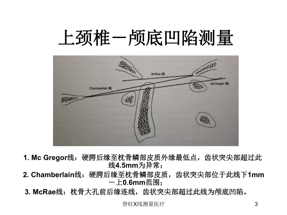 脊柱X线测量医疗培训课件.ppt_第3页