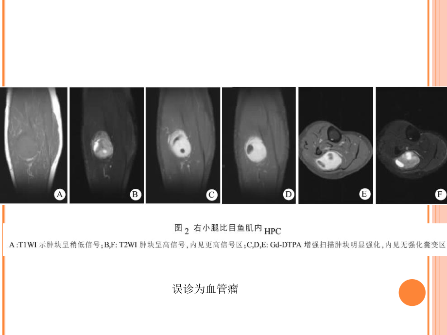 颅内血管外皮细胞瘤的影像学表现汇编课件.ppt_第2页