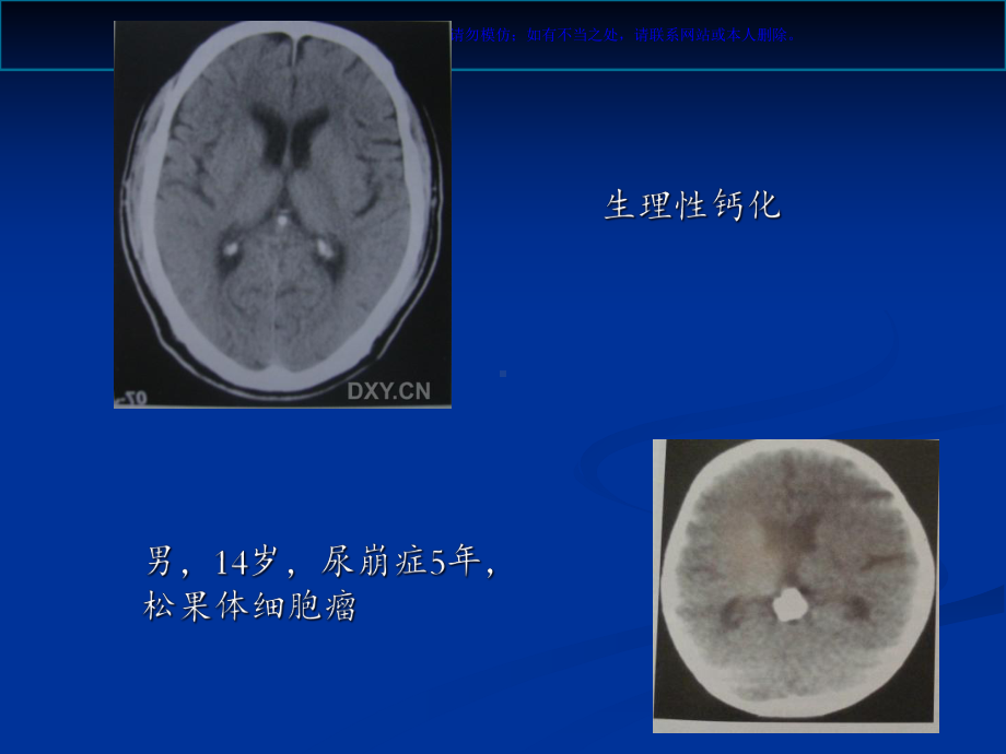 颅内钙化和其相关疾病课件.ppt_第2页