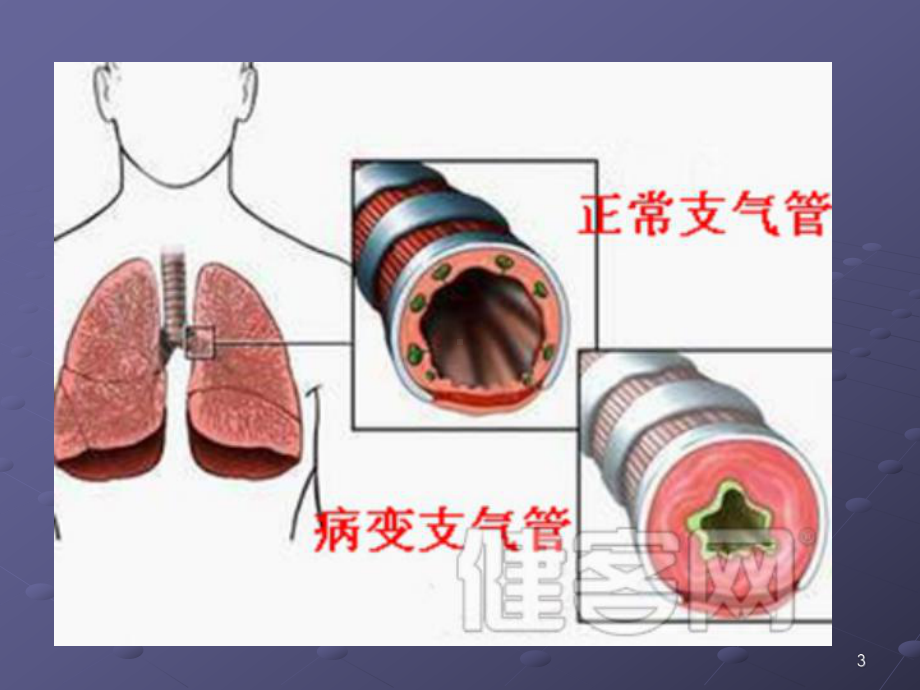 支气管扩张症护理查房(课堂)课件.ppt_第3页