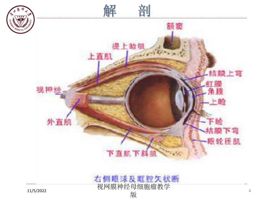 视网膜神经母细胞瘤教学版培训课件.ppt_第3页