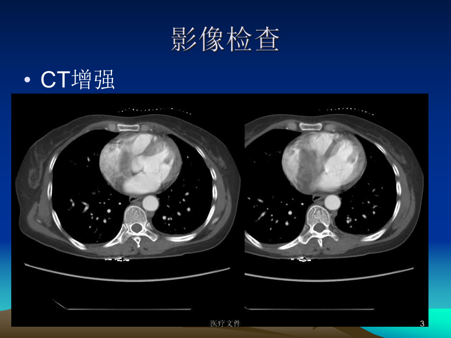 静脉内平滑肌瘤病一例病例讨论(医疗研究)课件.ppt_第3页