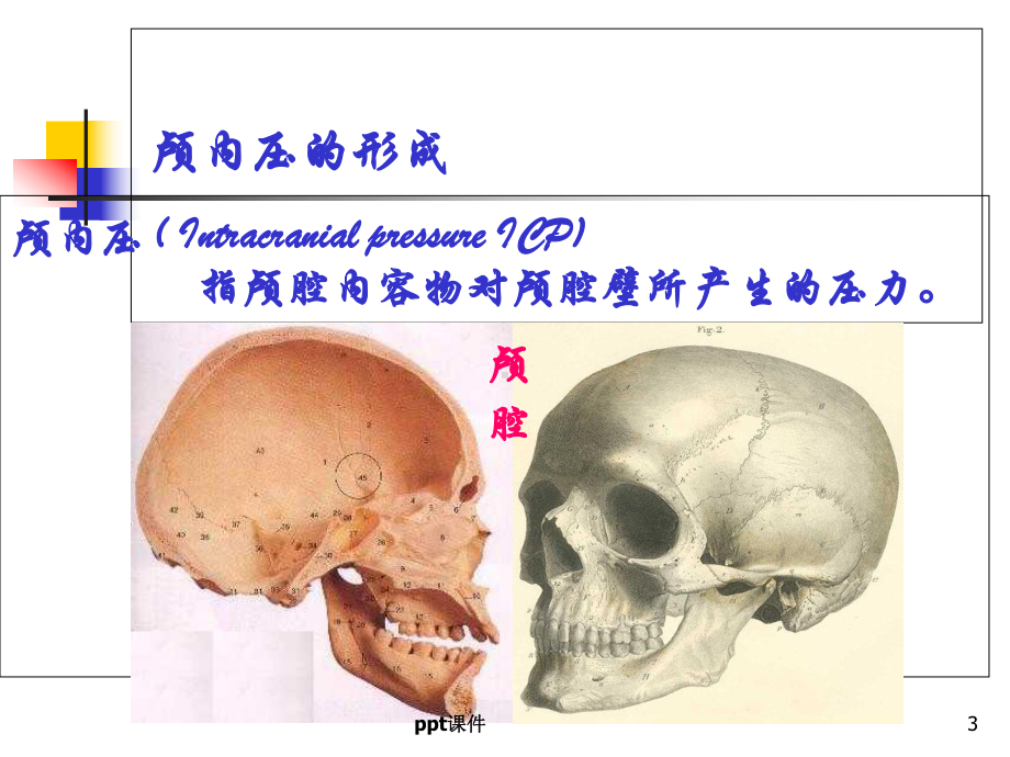 颅内压增高患者的护理-课件.ppt_第3页