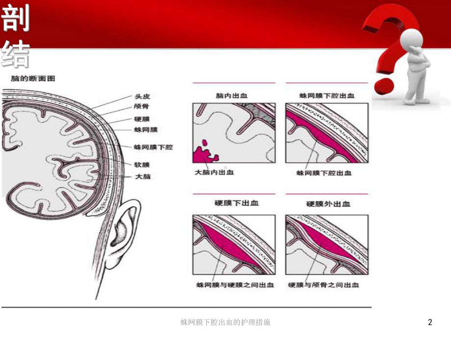 蛛网膜下腔出血的护理措施培训课件.ppt_第2页