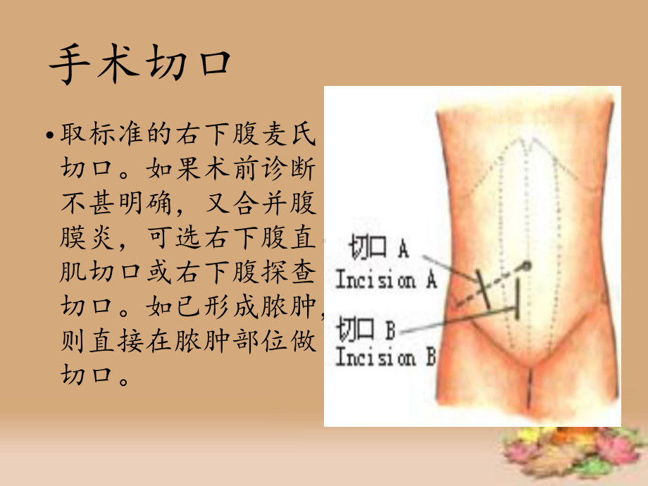 阑尾切除术的手术配合版课件.pptx_第3页