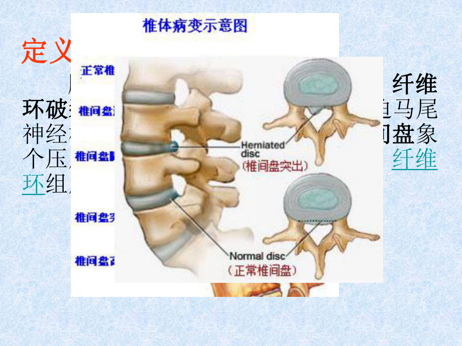 腰突的护理查房-课件.pptx_第3页