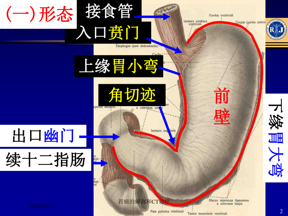 胃癌的解剖和CT诊疗培训课件.ppt_第2页