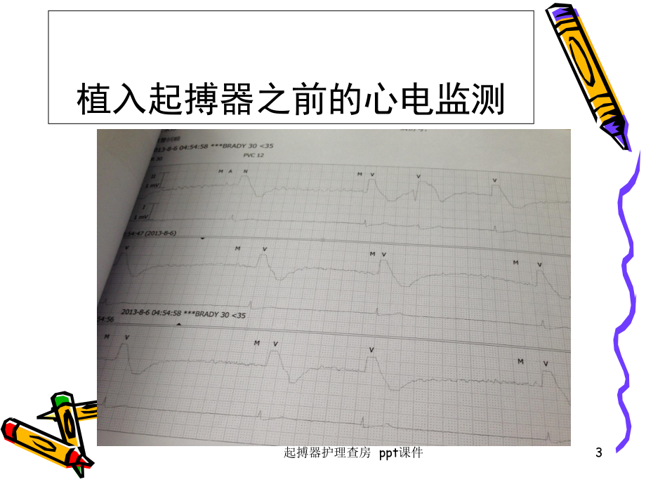 起搏器护理查房-课件.ppt_第3页