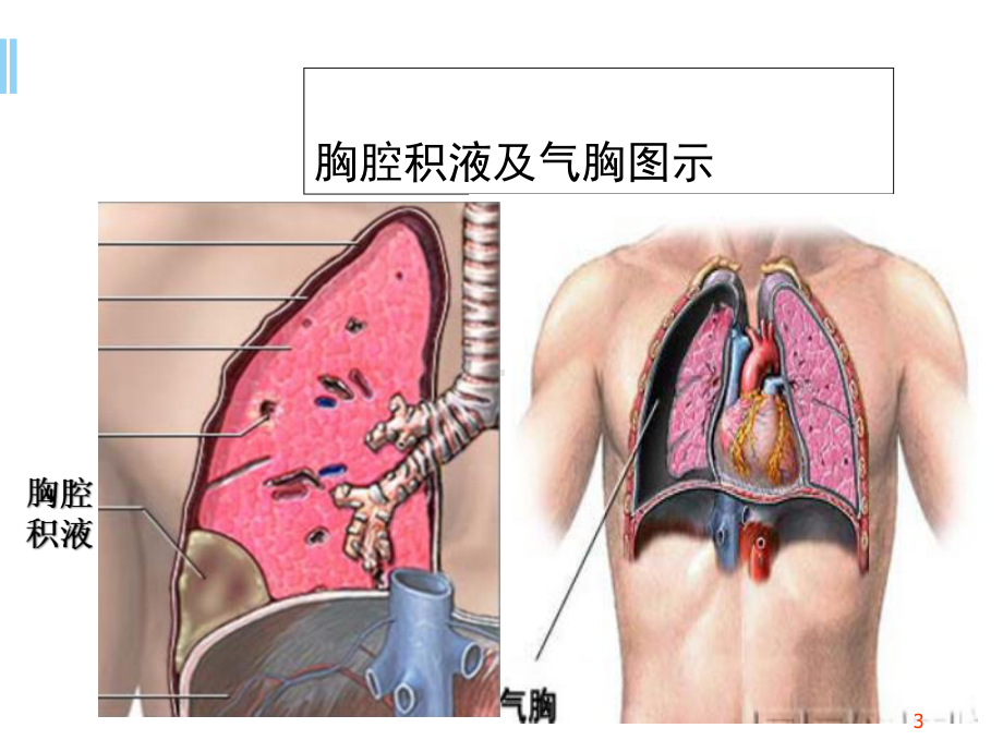 胸腔穿刺+技能操作优质课件.ppt_第3页