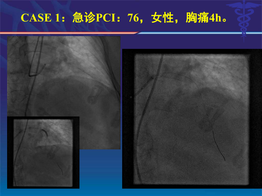 直接PCI术中无复流慢血流的应对策略课件.ppt_第2页