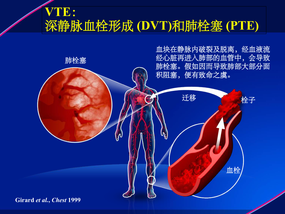 静脉血栓(VTE)防治解读课件-3.ppt_第3页