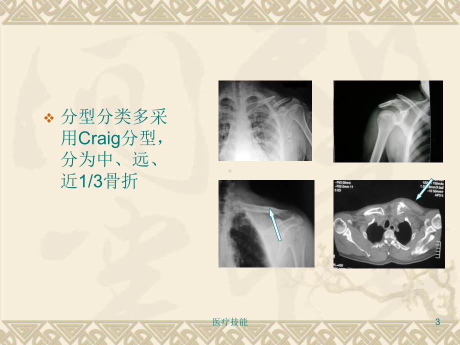 锁骨骨折闭合穿针术(医学技术)课件.ppt_第3页