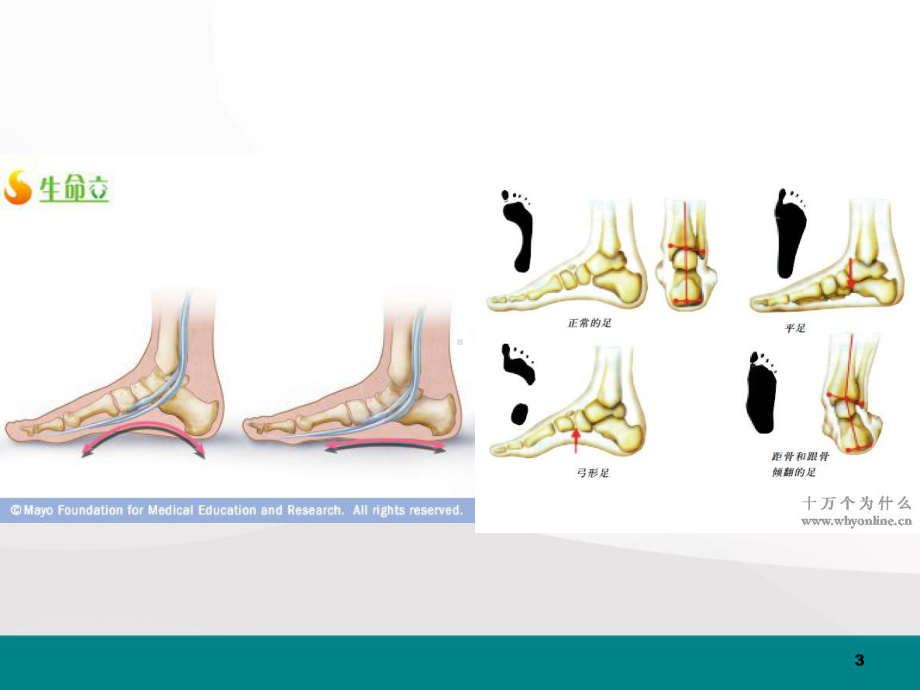 扁平足医学课件.ppt_第3页