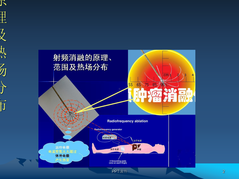 肿瘤射频消融治疗的创新技术-课件.ppt_第2页