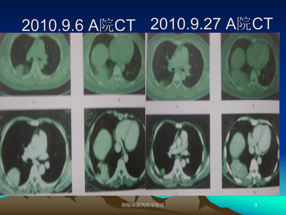 肺隐球菌病医学知识培训课件.ppt_第3页