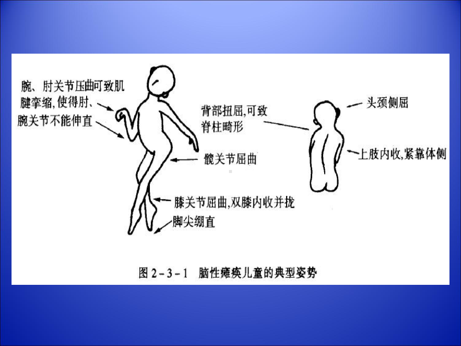 小儿脑瘫康复-课件.ppt_第3页