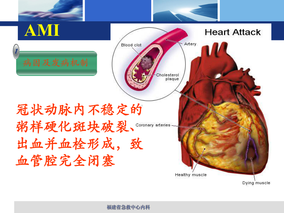 急性心肌梗死课件2.ppt_第3页