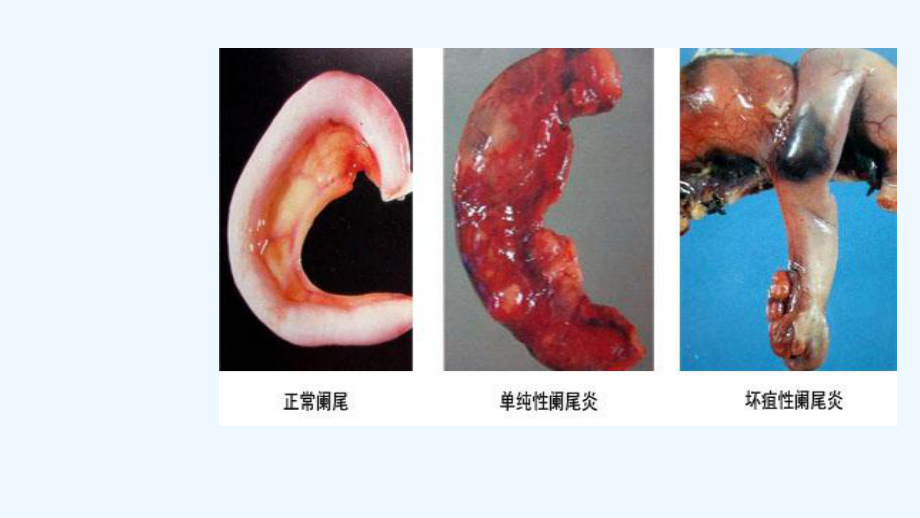 阑尾炎要点及习题讲解课件.ppt_第3页