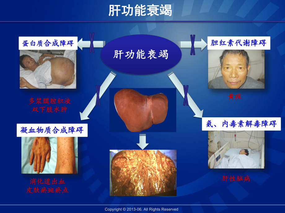 非生物型人工肝治疗肝衰竭指南课件.pptx_第3页