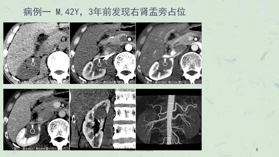 肾脏占位病例随访课件.ppt_第3页