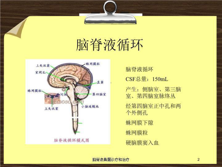 脑脊液鼻漏诊疗和治疗培训课件.ppt_第2页