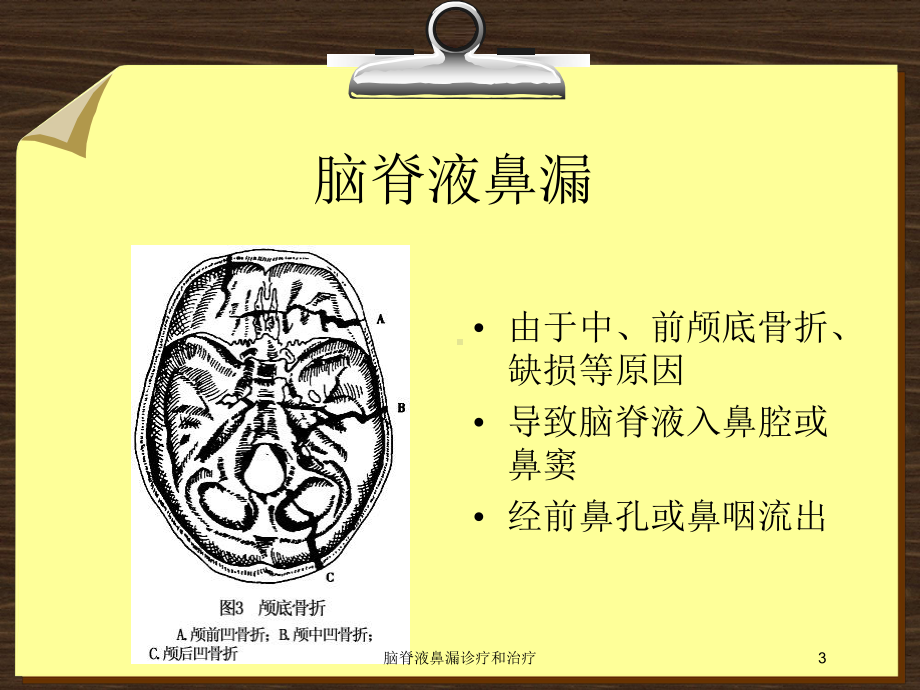 脑脊液鼻漏诊疗和治疗培训课件.ppt_第3页