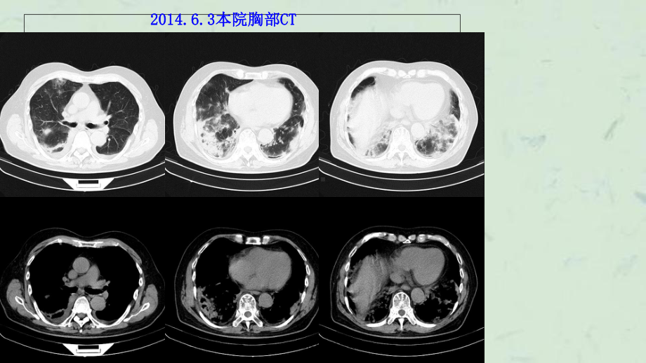 隐源性机化性肺炎课件.ppt_第3页