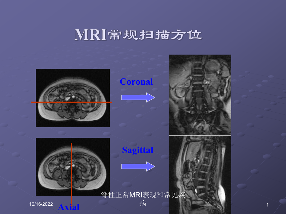 脊柱正常MRI表现和常见疾病培训课件.ppt_第1页