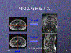 脊柱正常MRI表现和常见疾病培训课件.ppt