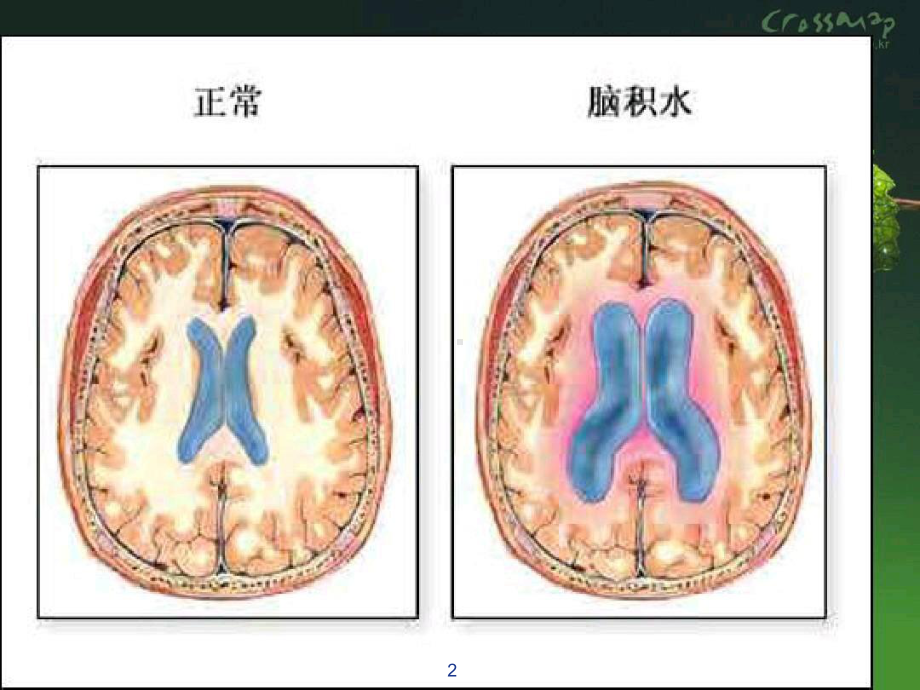 脑积水武红芳副本副本课件.ppt_第2页