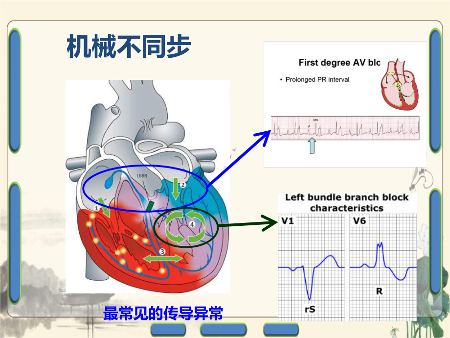 心力衰竭患者CRT治疗适应证和时机课件.ppt_第3页