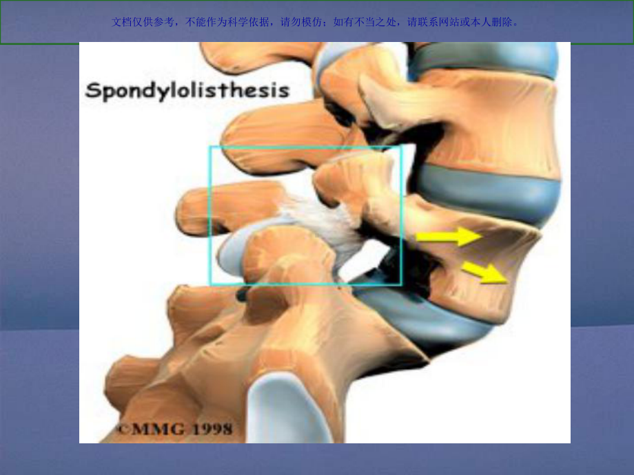 腰椎滑脱介绍课件.ppt_第3页