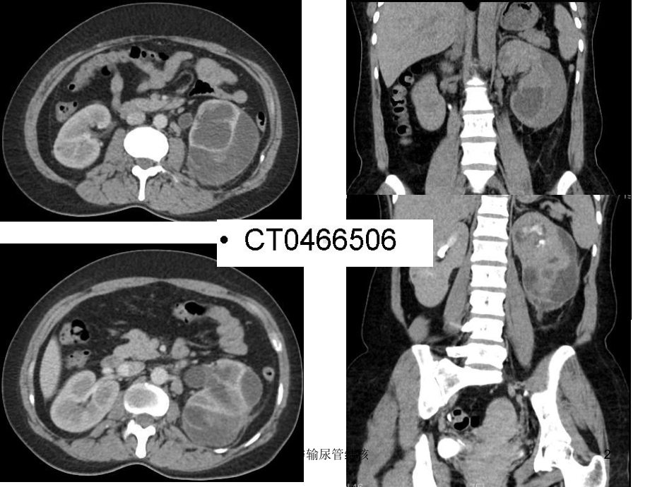 肾与输尿管结核课件.ppt_第2页