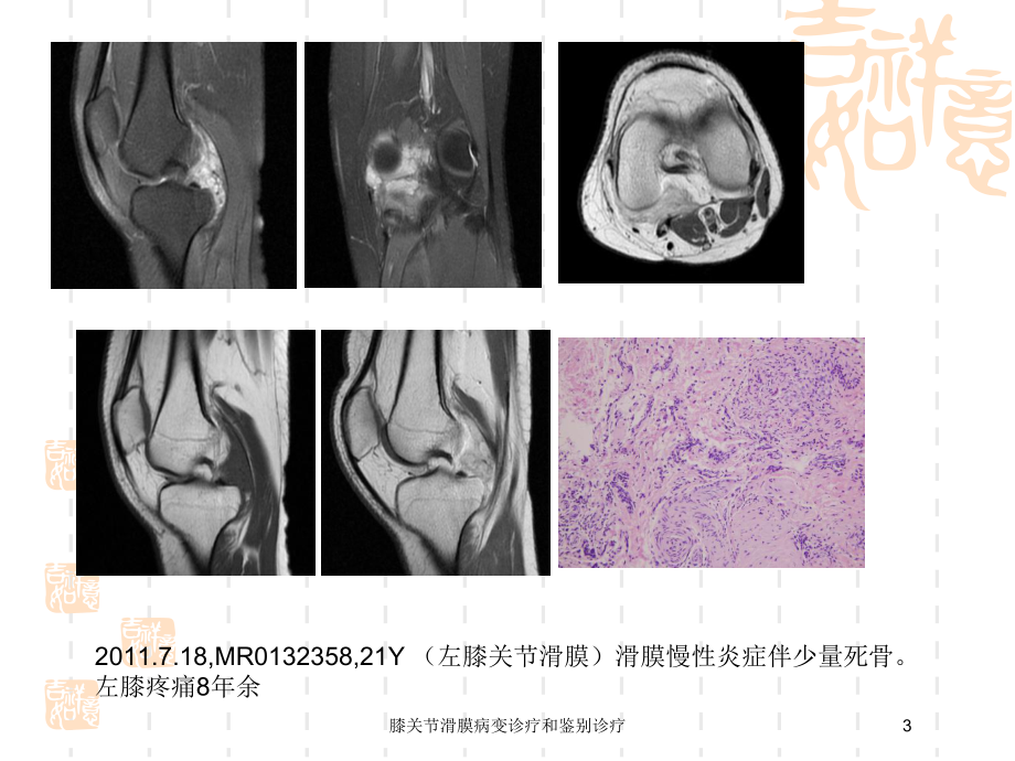 膝关节滑膜病变诊疗和鉴别诊疗培训课件.ppt_第3页