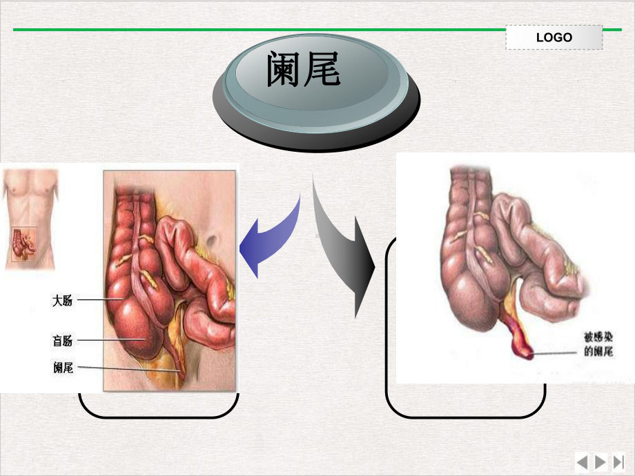 阑尾切除术护理配合谷课件完整版.pptx_第3页